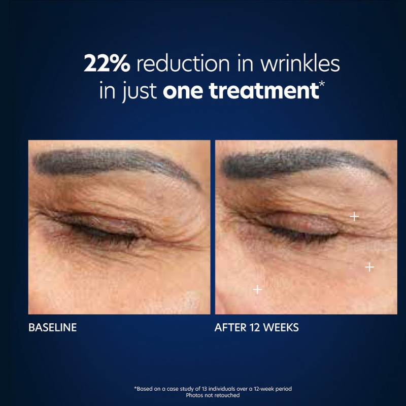 Hyaluronic Acid Microneedle Eye Patches